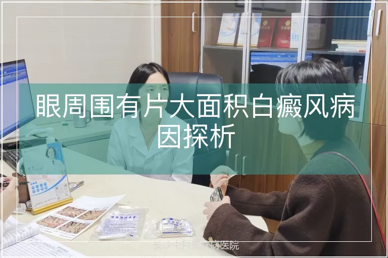 眼周围有片大面积白癜风病因探析