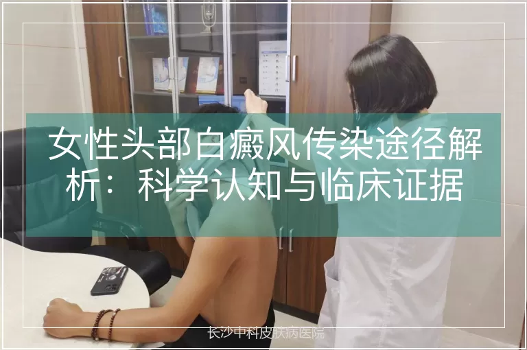 女性头部白癜风传染途径解析:科学认知与临床证据