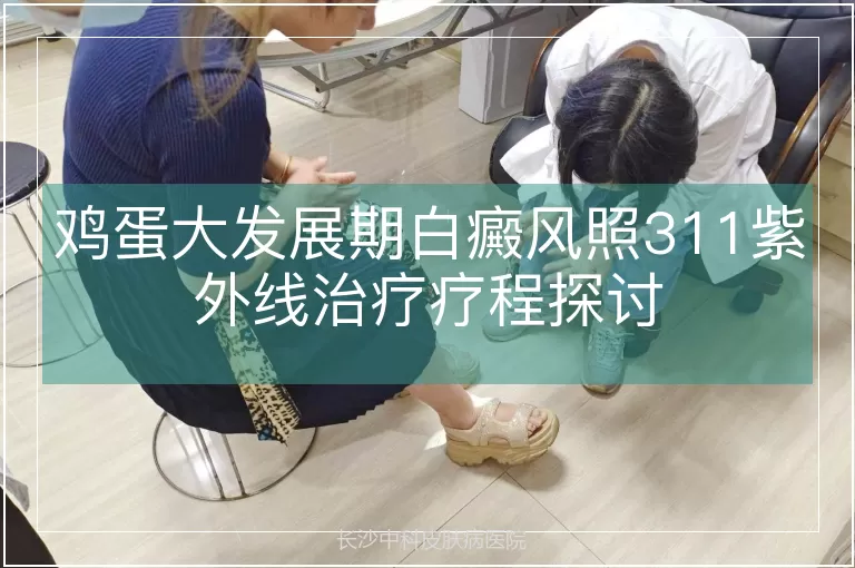 鸡蛋大发展期白癜风照311紫外线治疗疗程探讨