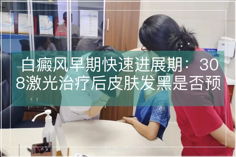 白癜风早期快速进展期:308激光治疗后皮肤发黑是否预示病情好转?