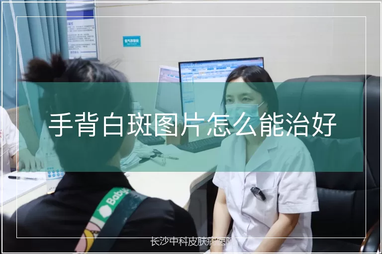 手背白斑图片怎么能治好