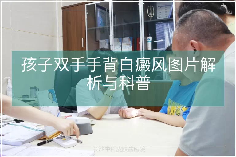 孩子双手手背白癜风图片解析与科普