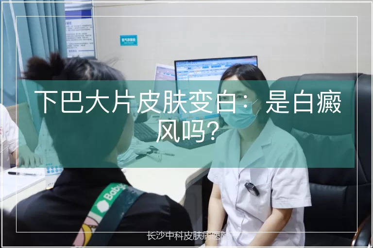 下巴大片皮肤变白:是白癜风吗?