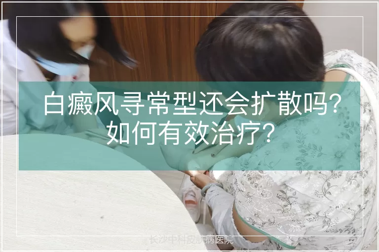 白癜风寻常型还会扩散吗?如何有效治疗?