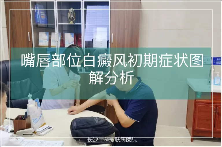 嘴唇部位白癜风初期症状图解分析