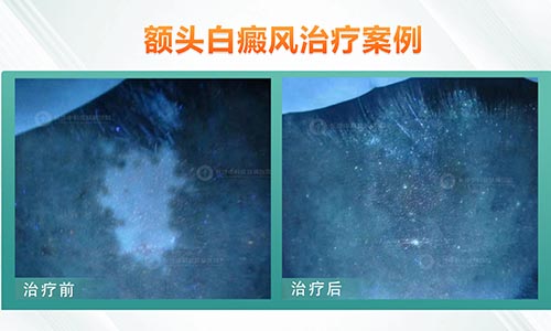 女，22岁 额头白癜风1年